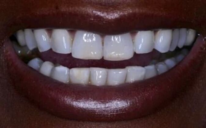 Veneers: Tiara - Before