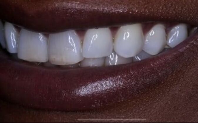 Veneers: Tiara - Before