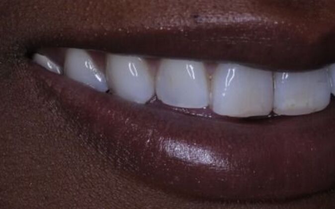 Veneers: Tiara - Before