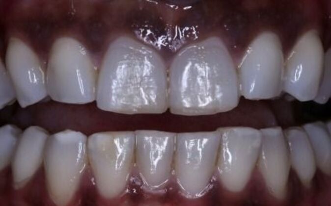 Veneers Tiara - Before
