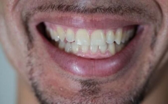Invisalign Cases