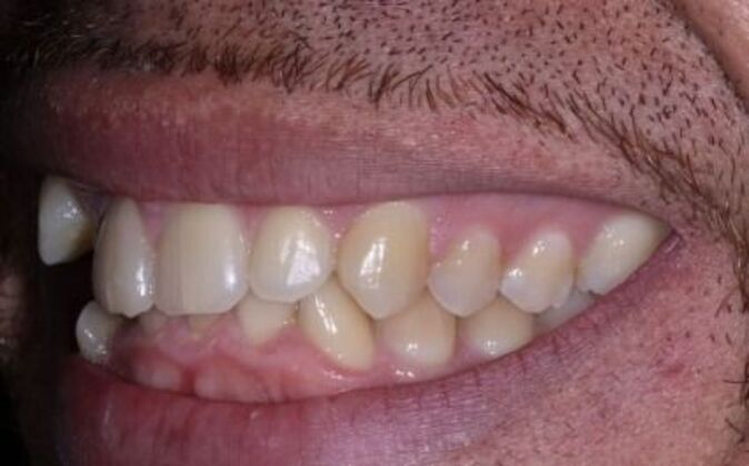 Invisalign: Pablo - Before