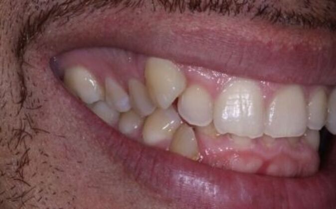 Invisalign: Pablo - Before