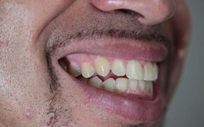 Invisalign: Pablo - After