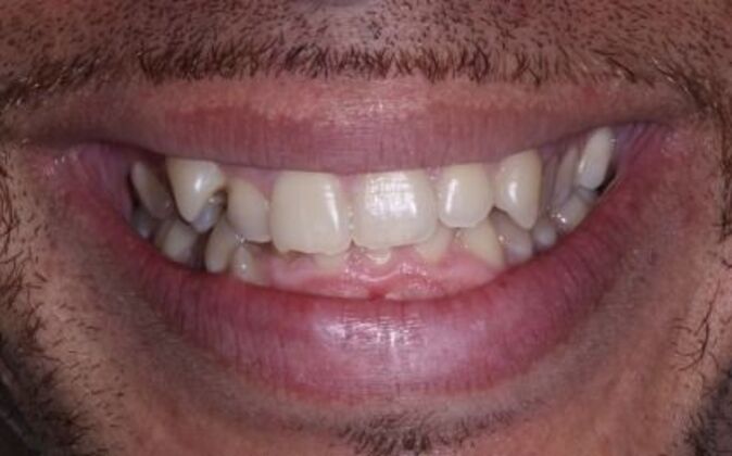 Invisalign Pablo - Before