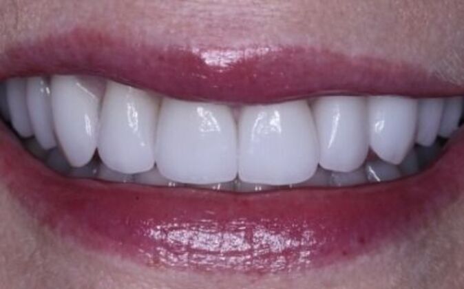 Dental Implants Case