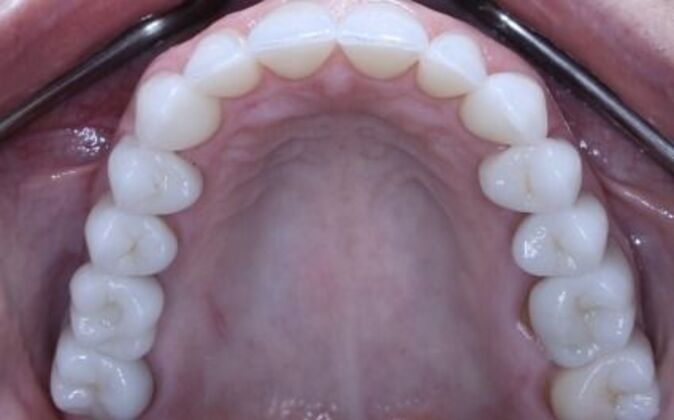 Dental Implants: Valerie - After