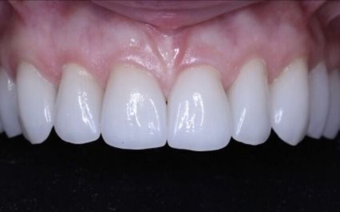 Dental Implants: Valerie - After
