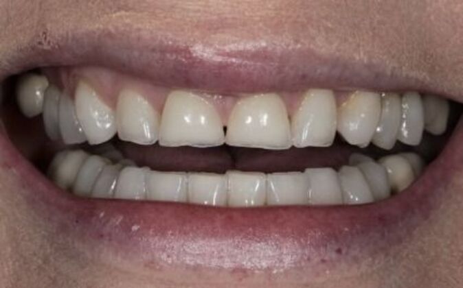 Dental Implants Valerie - Before