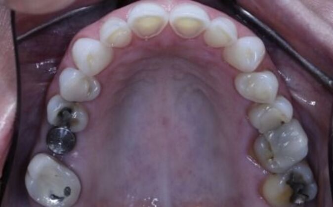 Dental Implants: Valerie - Before