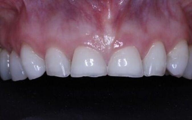 Dental Implants: Valerie - Before