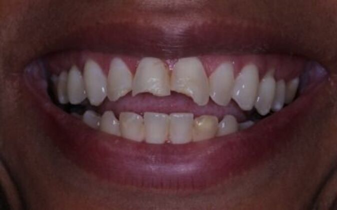 Full Mouth Reconstruction Natasha - Before