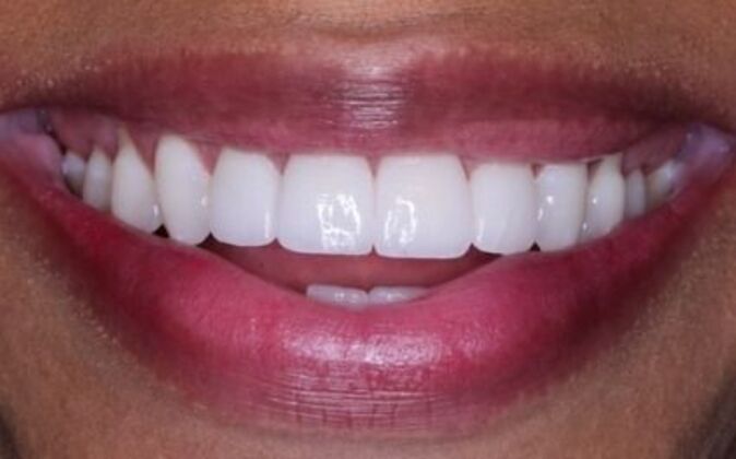 Full Mouth Reconstruction Natasha - After