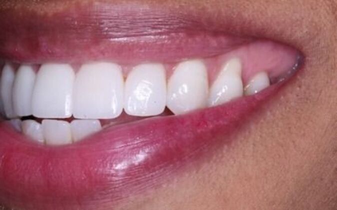 Full Mouth Reconstruction: Natasha - After