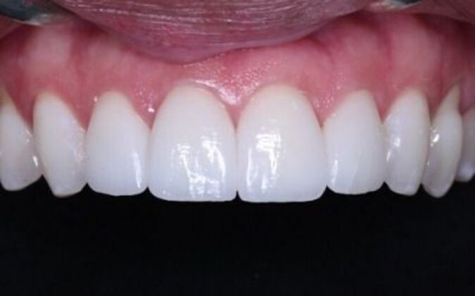 Full Mouth Reconstruction: Natasha - After