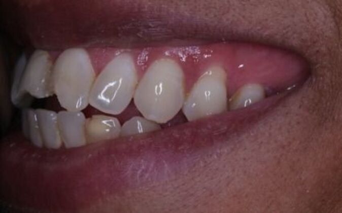 Full Mouth Reconstruction: Natasha - Before