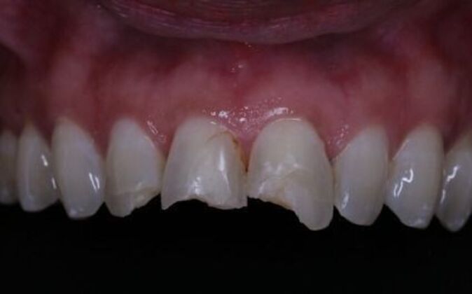 Full Mouth Reconstruction: Natasha - Before