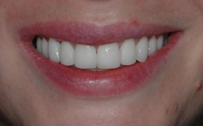 Veneers Diane Neal - After