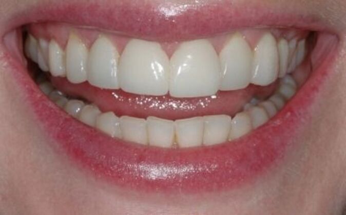 Veneers Diane Neal - Before