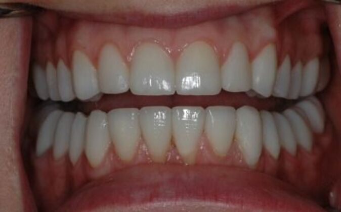 Full Mouth Reconstruction Elizabeth - After