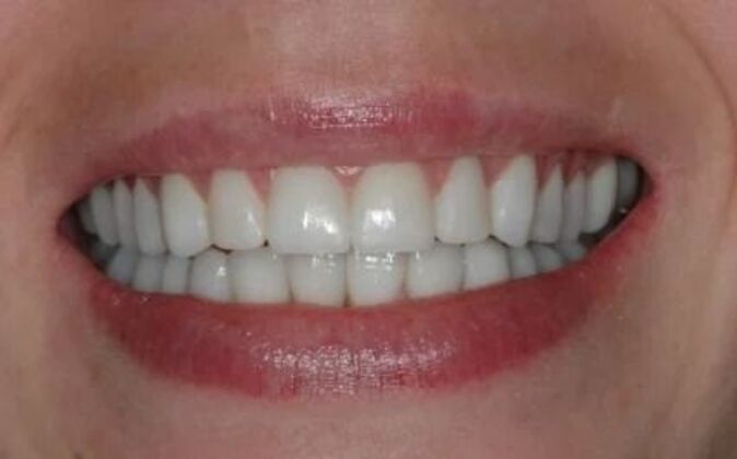 Full Mouth Reconstruction: Elizabeth - After