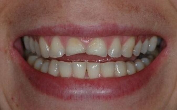 Full Mouth Reconstruction: Elizabeth - Before