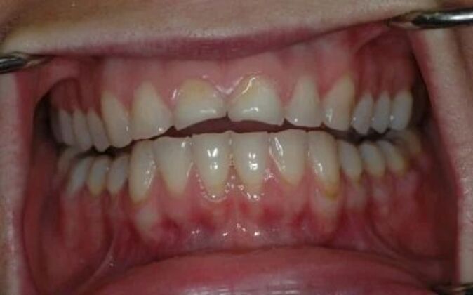 Full Mouth Reconstruction Elizabeth - Before