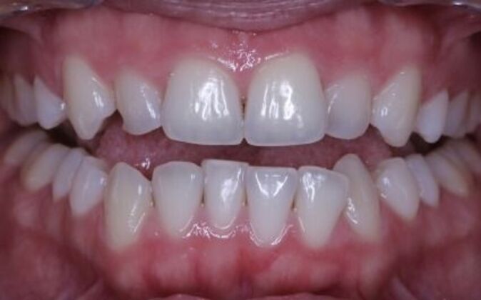 Invisalign Alicia - Before