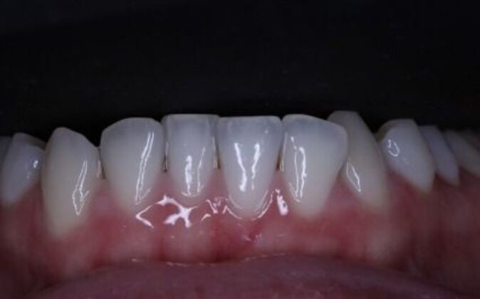 Invisalign: Alicia - Before