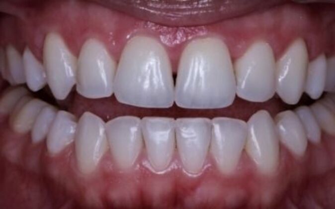 Invisalign Alicia - After