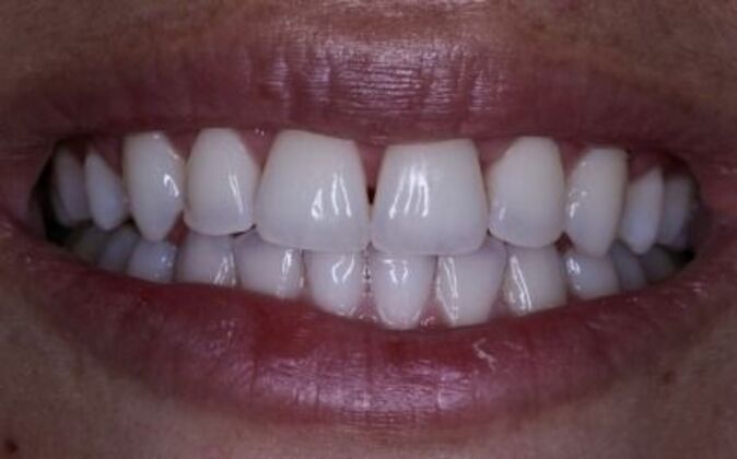 Invisalign: Alicia - After