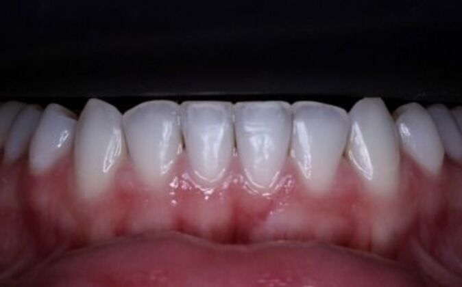 Invisalign: Alicia - After