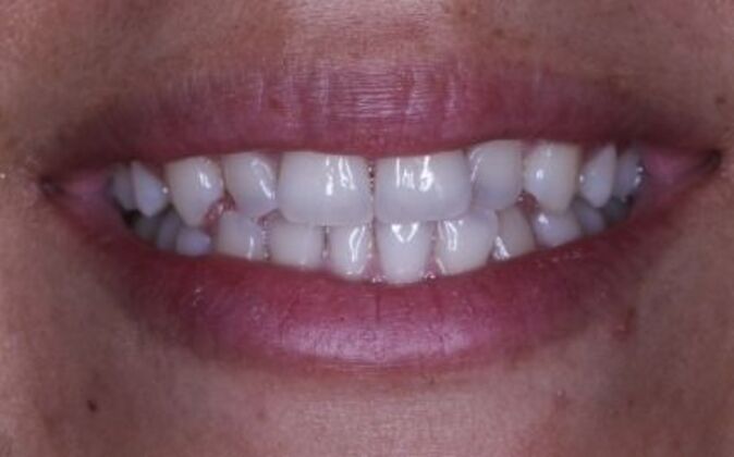 Invisalign: Alicia - Before