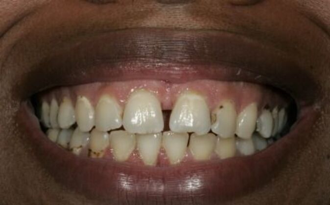 Full Mouth Reconstruction Nicole - Before