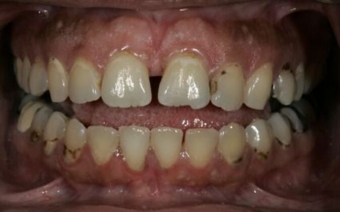 Full Mouth Reconstruction: Nicole - Before