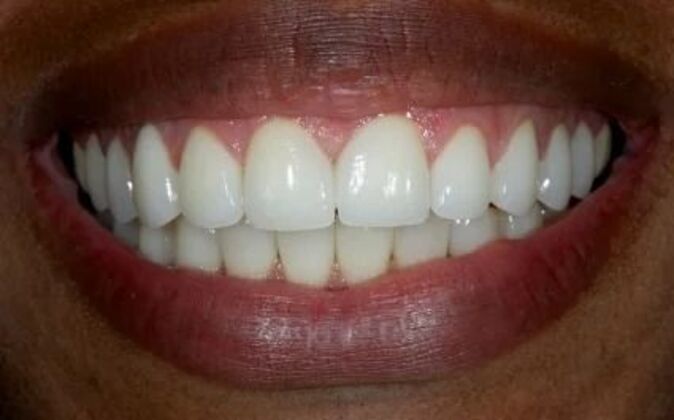 Full Mouth Reconstruction Nicole - After