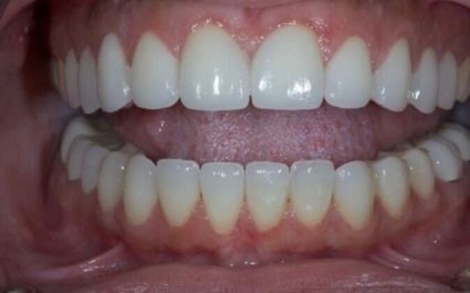 Full Mouth Reconstruction: Nicole - After