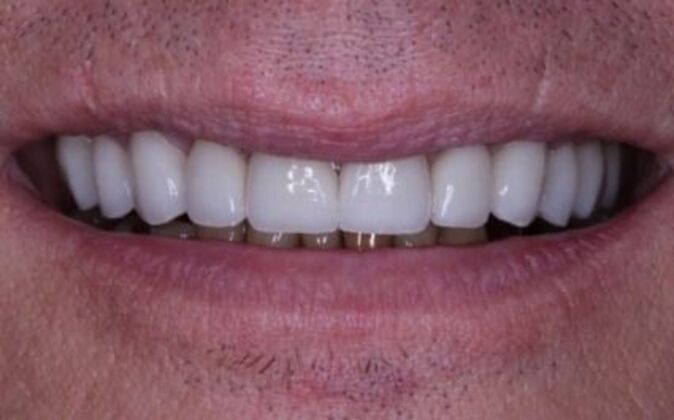 Smile Makeover Jerry - After