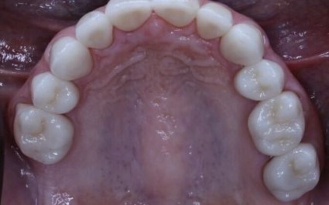 Smile Makeover: Jerry - After