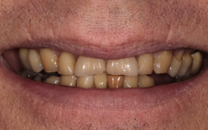 Smile Makeover Jerry - Before