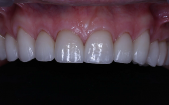 Smile Makeover: Jerry - After