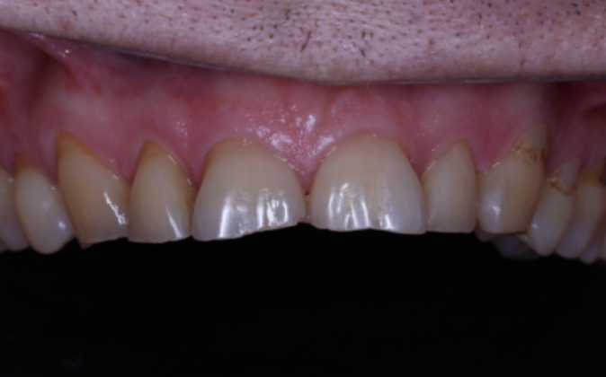 Smile Makeover: Jerry - Before