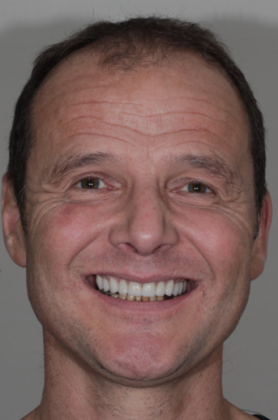 Smile Makeover: Jerry - After