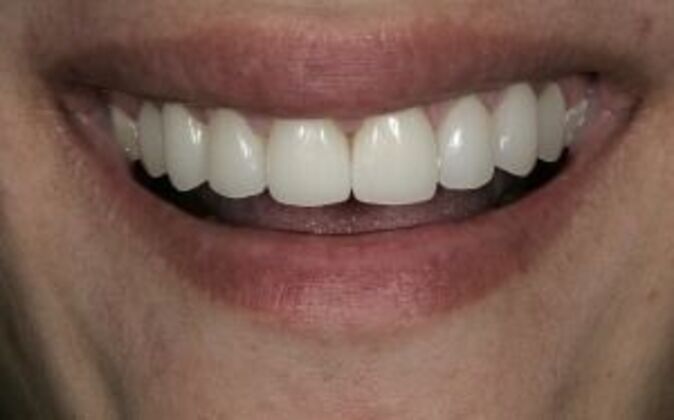 Smile Makeover Nick - After