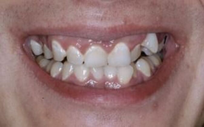 Smile Makeover Nick - Before