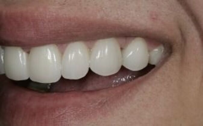 Smile Makeover: Nick - After