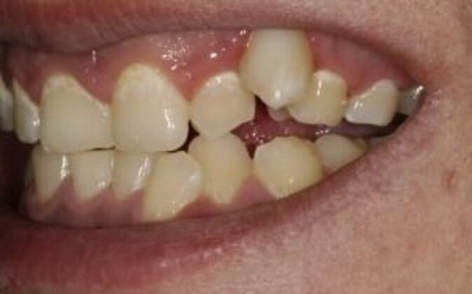 Smile Makeover: Nick - Before