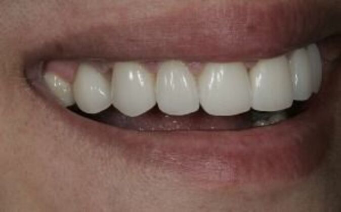 Smile Makeover: Nick - After