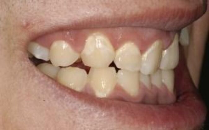 Smile Makeover: Nick - Before