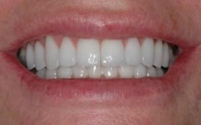 Veneers Marci - After
